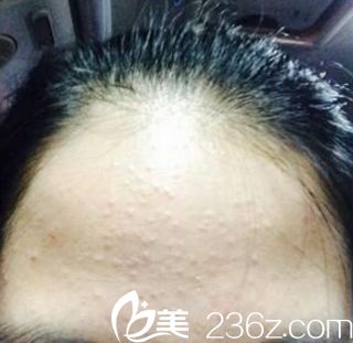 痘痘类型有哪些