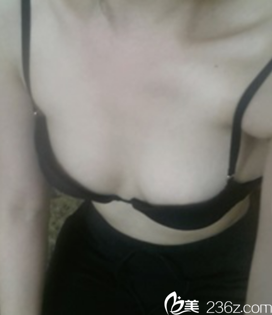 韩国赫尔希金应森院长做假体隆胸好吗? 韩国赫尔希金应森院长做假体隆胸好吗?