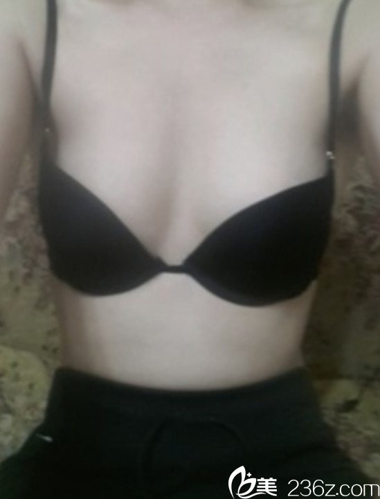 韩国赫尔希隆胸真人案例 韩国赫尔希隆胸真人案例