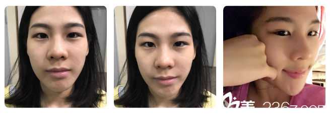 双眼皮术前照片 双眼皮术前照片