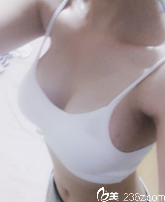 金应森院长做假体隆胸真人案例 金应森院长做假体隆胸真人案例