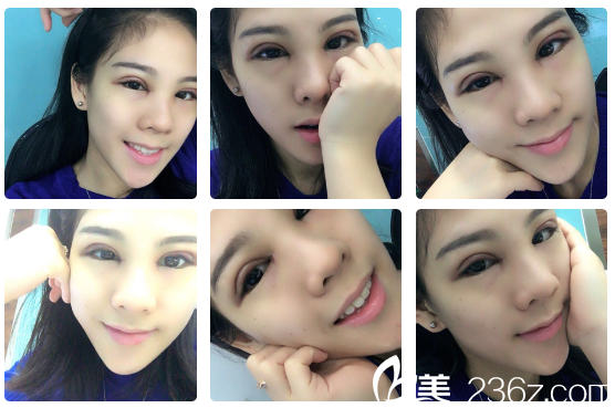 在广州军美找产慎之做完双眼皮第二天 在广州军美找产慎之做完双眼皮第二天