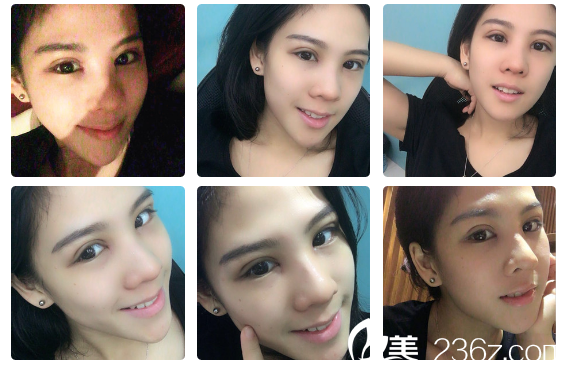 广州军美产慎之做完双眼皮8天自拍 广州军美产慎之做完双眼皮8天自拍