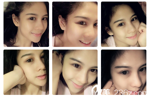 找广州军美产慎之割完双眼皮1个月了 找广州军美产慎之割完双眼皮1个月了