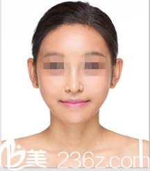 看泰国妹子在韩国DREAM做双鄂+鼻部整形恢复照，金永晙院长案例