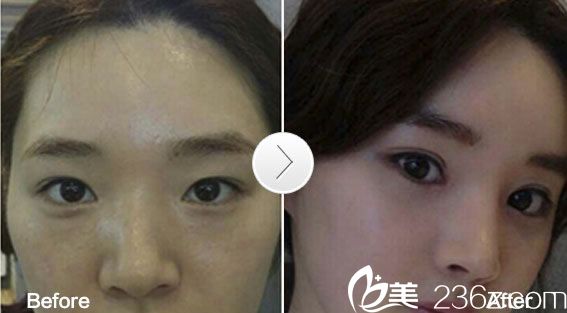 微创三点双眼皮真人 微创三点双眼皮真人