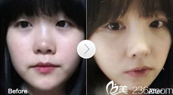 埋线法双眼皮真人 埋线法双眼皮真人