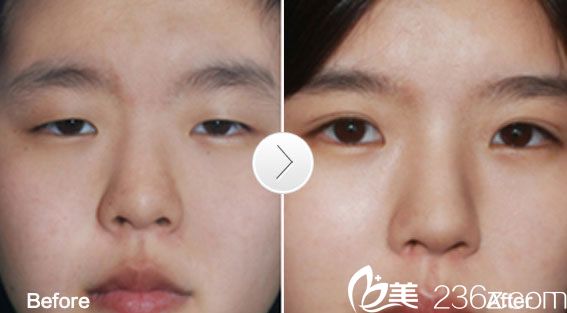 尚丽全切双眼皮 尚丽全切双眼皮