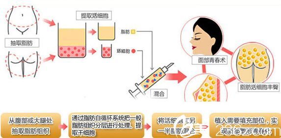 自体脂肪填充原理