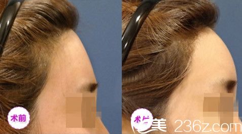 额部脂肪填充对比图