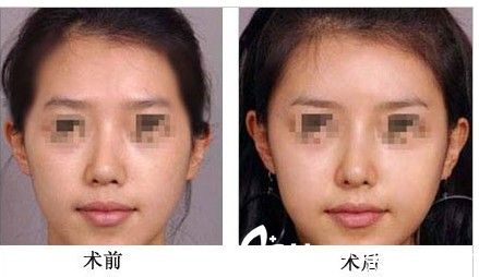 颞部（太阳穴）脂肪填充前后对比