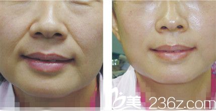 法令纹脂肪填充前后对比图