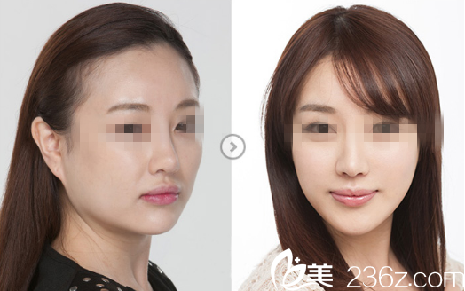 侧面部脂肪填充前后对比