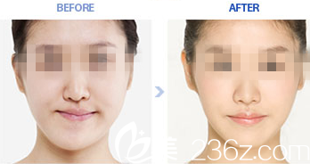 改善面部不对称畸形前后对比图
