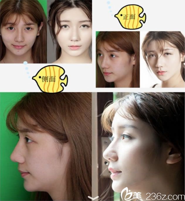 宁波薇琳刘波自体脂肪填充面部案例 宁波薇琳刘波自体脂肪填充面部案例