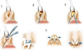 韩国iFace整形外科医院鼻部整形示意图 韩国iFace整形外科医院鼻部整形示意图