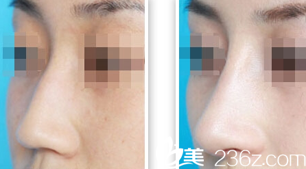 韩国iFace整形外科医院案例 韩国iFace整形外科医院案例