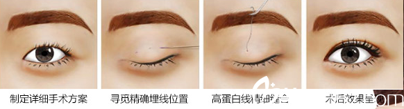 邱文苑医生讲述埋线法过程