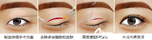 切割法割双眼皮你了解多少？上海伊莱美整形医院邱文苑医生告诉你