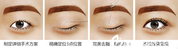 三点定位法是什么？<!--<i data=20240703-sp></i>-->伊莱美整形医院邱文苑医生告诉你。