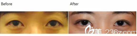 韩国iFace整形外科医院案例