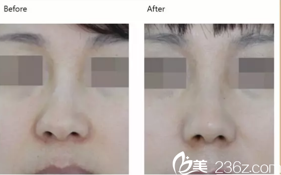 韩国iFace整形外科医院鼻部案例