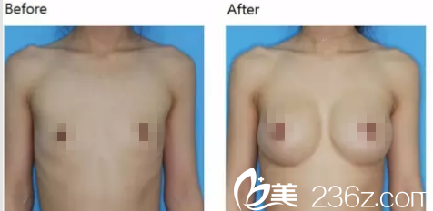 韩国iFace整形外科医院胸部案例