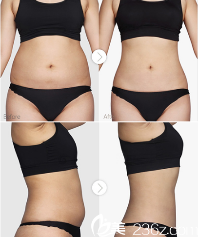 合肥福华李建云腹部吸脂案例对比图 合肥福华李建云腹部吸脂案例对比图