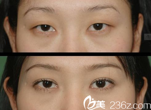 双眼皮术后效果好吗？上海伊莱美整形医院邱文苑医生给你看图。