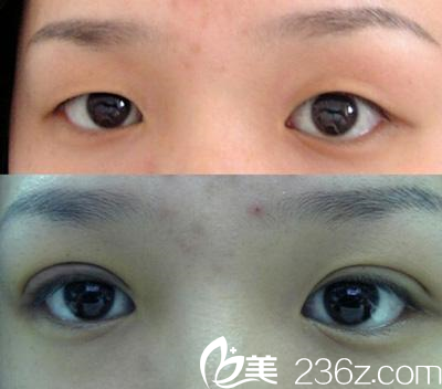 <!--<i data=20240703-sp></i>-->伊莱美整形医院效果好不好？看邱文苑医生的术后图就知道。