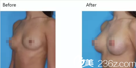 韩国iFace整形外科医院案例 韩国iFace整形外科医院案例