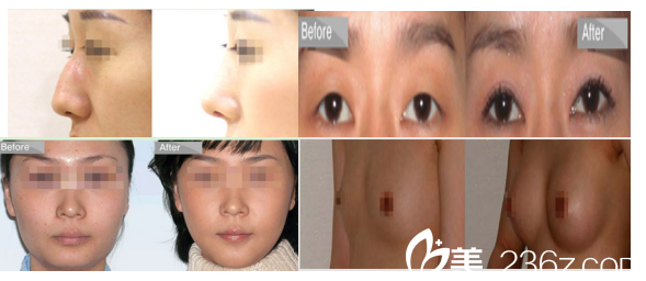 韩国olive整形外科医院案例 韩国olive整形外科医院案例