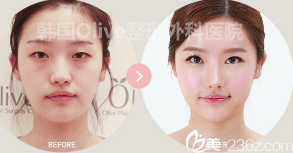olive整形鼻部案例