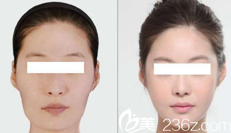 olive整形面部轮廓案例