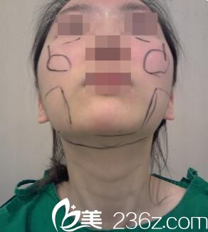  韩国Small Face整形外科真人案例2