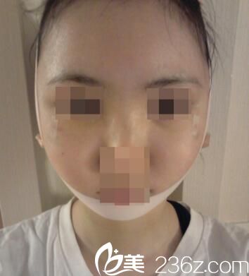  韩国Small Face整形外科真人案例3