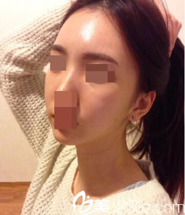   韩国Small Face整形外科张镐做面部轮廓效果好不好？颧骨和面部吸脂真人手术案例