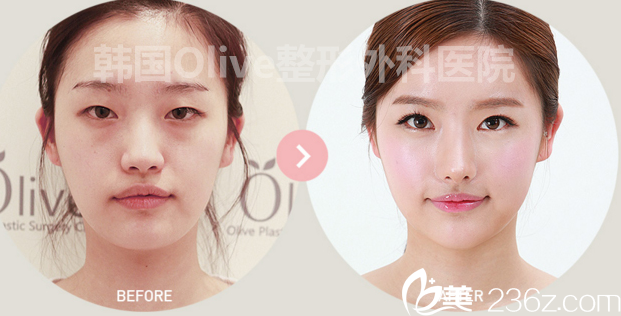 olive整形外科医院案例 olive整形外科医院案例