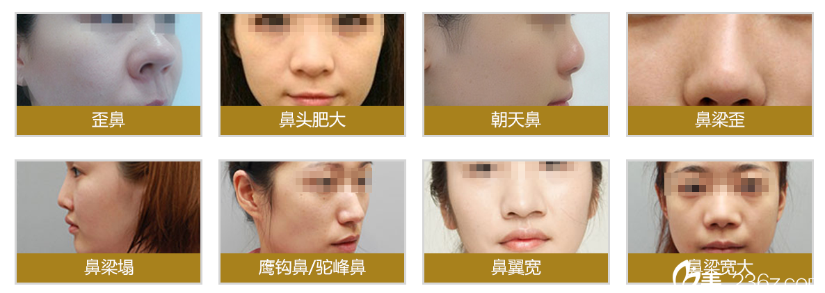 吴玉家医生列举各种影响美观的鼻部形态