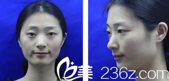 厦门欧菲注射玻尿酸前 厦门欧菲注射玻尿酸前