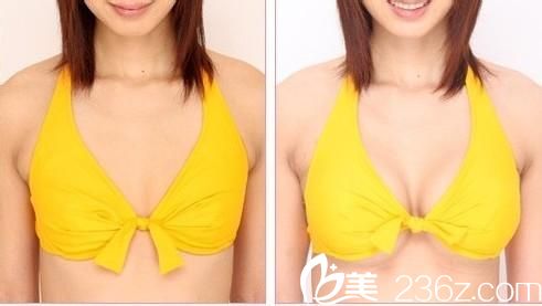 韩国高兰得自体脂肪隆胸对比图