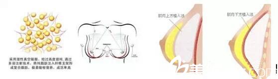 自体脂肪隆胸的手术误区