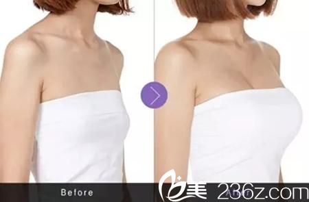 韩国高兰得自体脂肪隆胸前后对比图