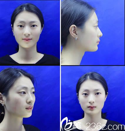 分享我找厦门欧菲注射玻尿酸隆鼻和丰太阳穴的恢复效果