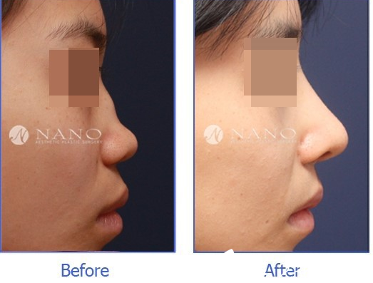 韩国Nano整形外科案例 韩国Nano整形外科案例