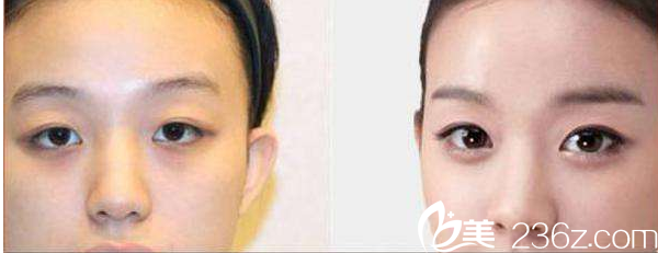 韩国Nano整形外科案例 韩国Nano整形外科案例