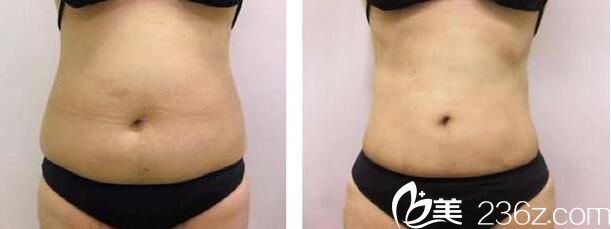 韩国wiz&美整形外科真人案例1 韩国wiz&美整形外科真人案例1