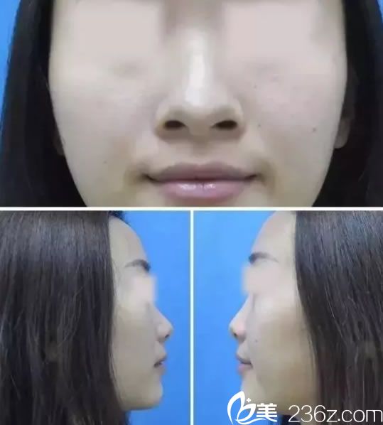 在建国整形做鼻综合前的塌鼻子 在建国整形做鼻综合前的塌鼻子