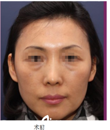 韩国Nano整形外科案例 韩国Nano整形外科案例