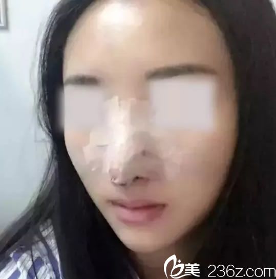 鼻综合整形手术第1天恢复期 鼻综合整形手术第1天恢复期